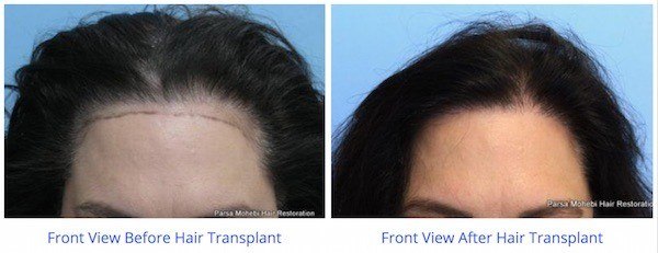 this is an image of hair transplant patient in Bel Air