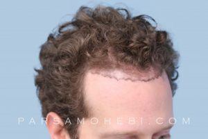 this is an image of hair transplant patient in Sunset District
