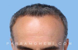 this is an image of hair transplant patient in Albany