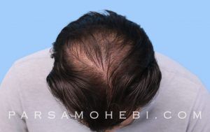 this is an image of hair transplant patient in Concord
