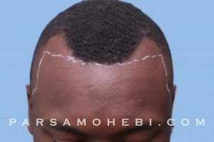 this is an image of hair transplant patient in Cupertino