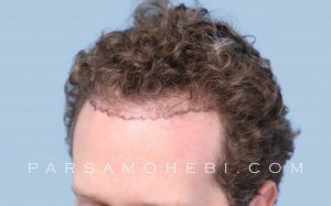 Follicular Unit Extraction (FUE) This hair transplant method is praised for its efficiency as it leaves no scar where the hair grafts are removed. We have listed some of the benefits of FUE below so you can learn more about this industry-leading procedure and the type of results you can expect to see after the procedure.