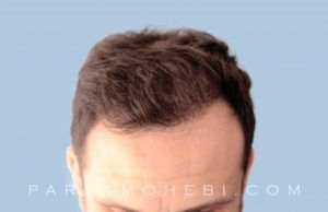 this is an image of hair transplant patient in Hayward