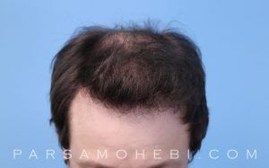 this is an image of hair transplant patient in Modesto