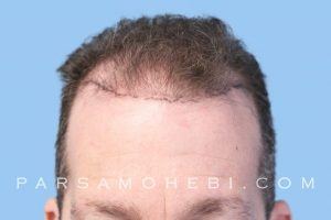 this is an image of hair transplant patient in Palo Alto