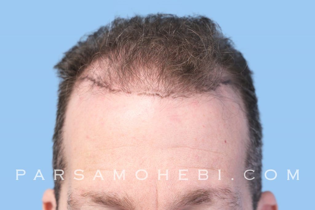 Palo Alto Hair Transplant Parsa Mohebi Hair Restoration