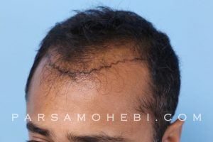this is an image of hair transplant patient in Piedmont