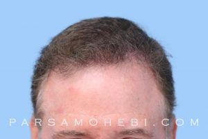 this is an image of hair transplant patient in Redwood City