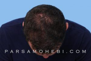 this is an image of hair transplant patient in Richmond