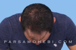 this is an image of hair transplant patient in Richmond