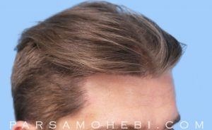 this is an image of hair transplant patient in San Jose