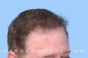this is an image of hair transplant patient in San Leandro