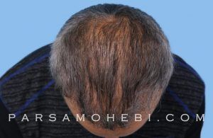 this is an image of hair transplant patient in San Mateo