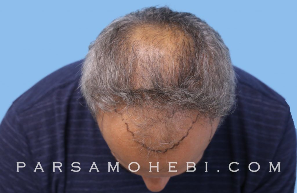 San Mateo Hair Transplant - Parsa Mohebi Hair Restoration - Parsa