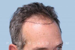 this is an image of hair transplant patient in Stockton