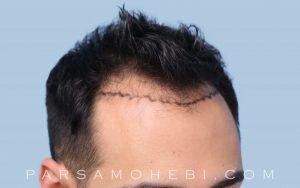 this is an image of hair transplant patient in Sunnyvale
