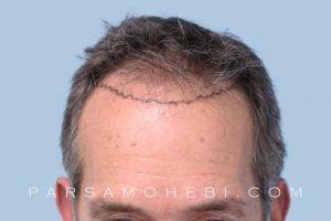 this is an image of hair transplant patient in Vallejo
