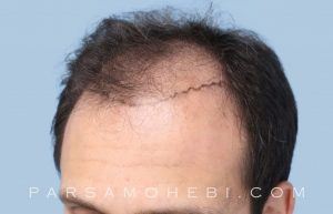 this is an image of hair transplant patient in Walnut Creek