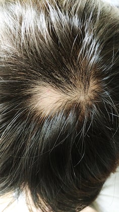 Alopecia Areata Explanation