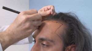 Hair Transplant Doctor Beverly Hills, CA