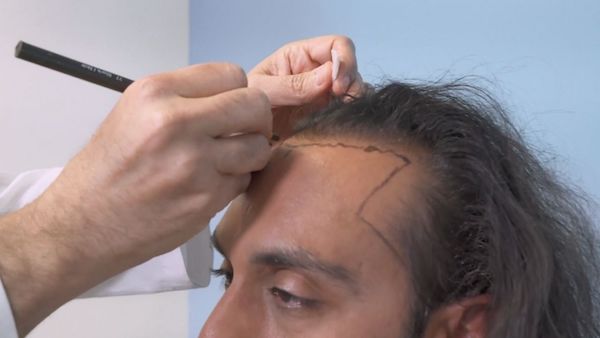 Dr. Gujrati, a hair transplant surgeon had a hair transplant