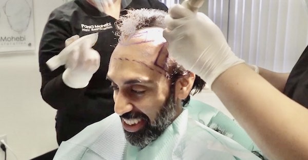 Hair Transplant surgeon shaving hair before hair transplant procedure