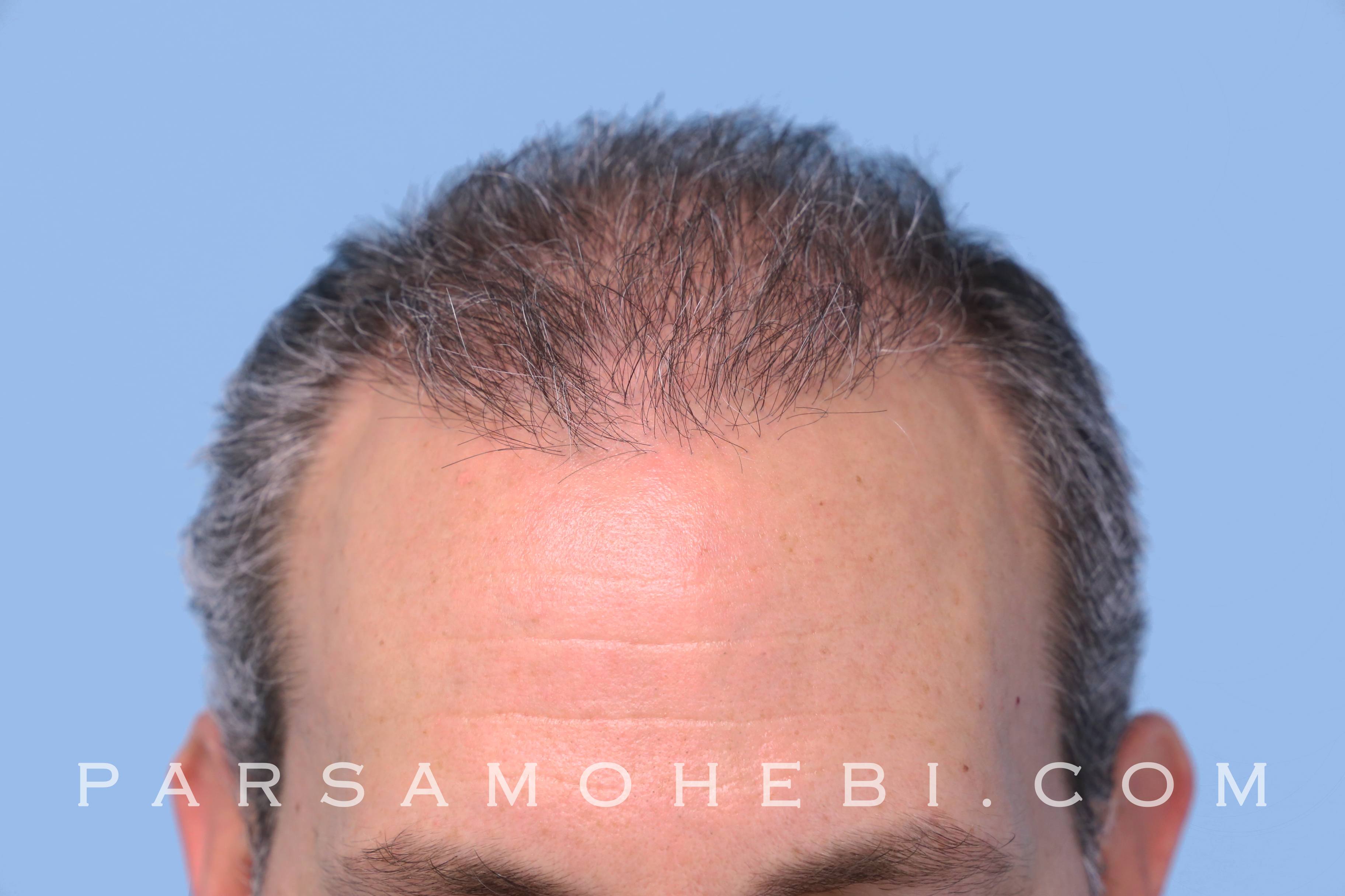 Los Angeles FUE Hair Transplant Surgery Explained - Cosmetic Town