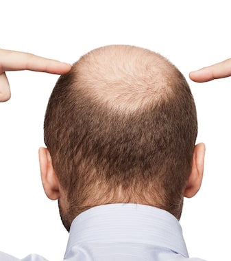 What can cause hair loss