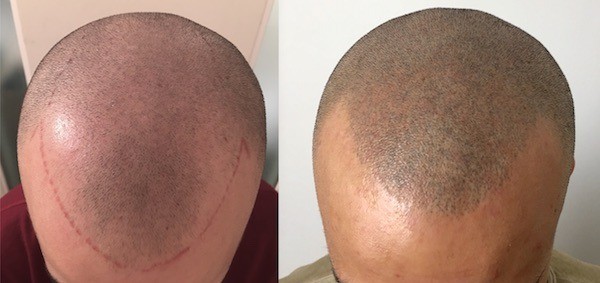 Scalp Micropigmentation before and after