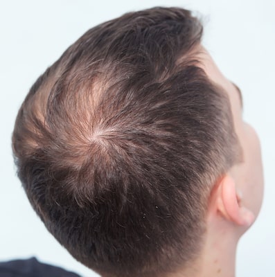 Male pattern baldness reasons