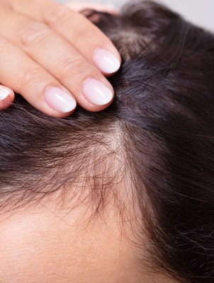 female hair loss signs
