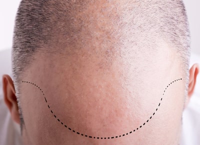 Limitations and Risks for Hairline Lowering