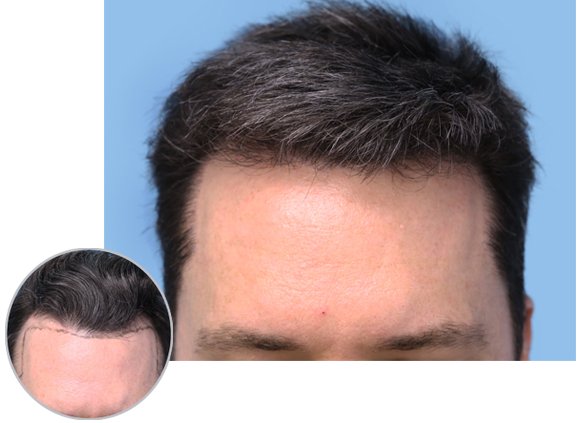 Before and After Men Hair Transplant