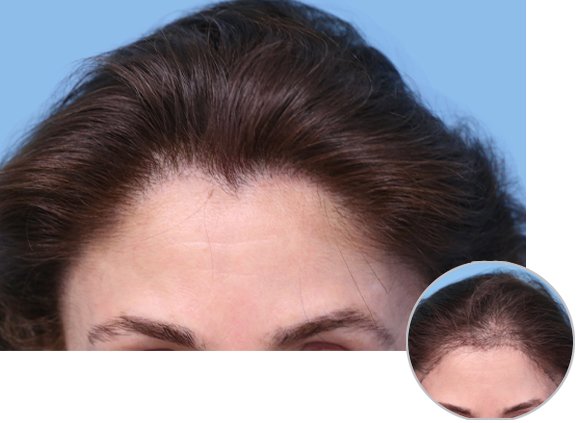 Before and After Female Hair Transplant