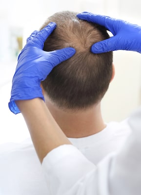 Androgenetic Alopecia related to Diabetes