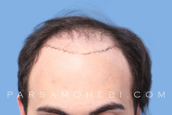Hair Transplant Stages - Parsa Mohebi Hair Restoration