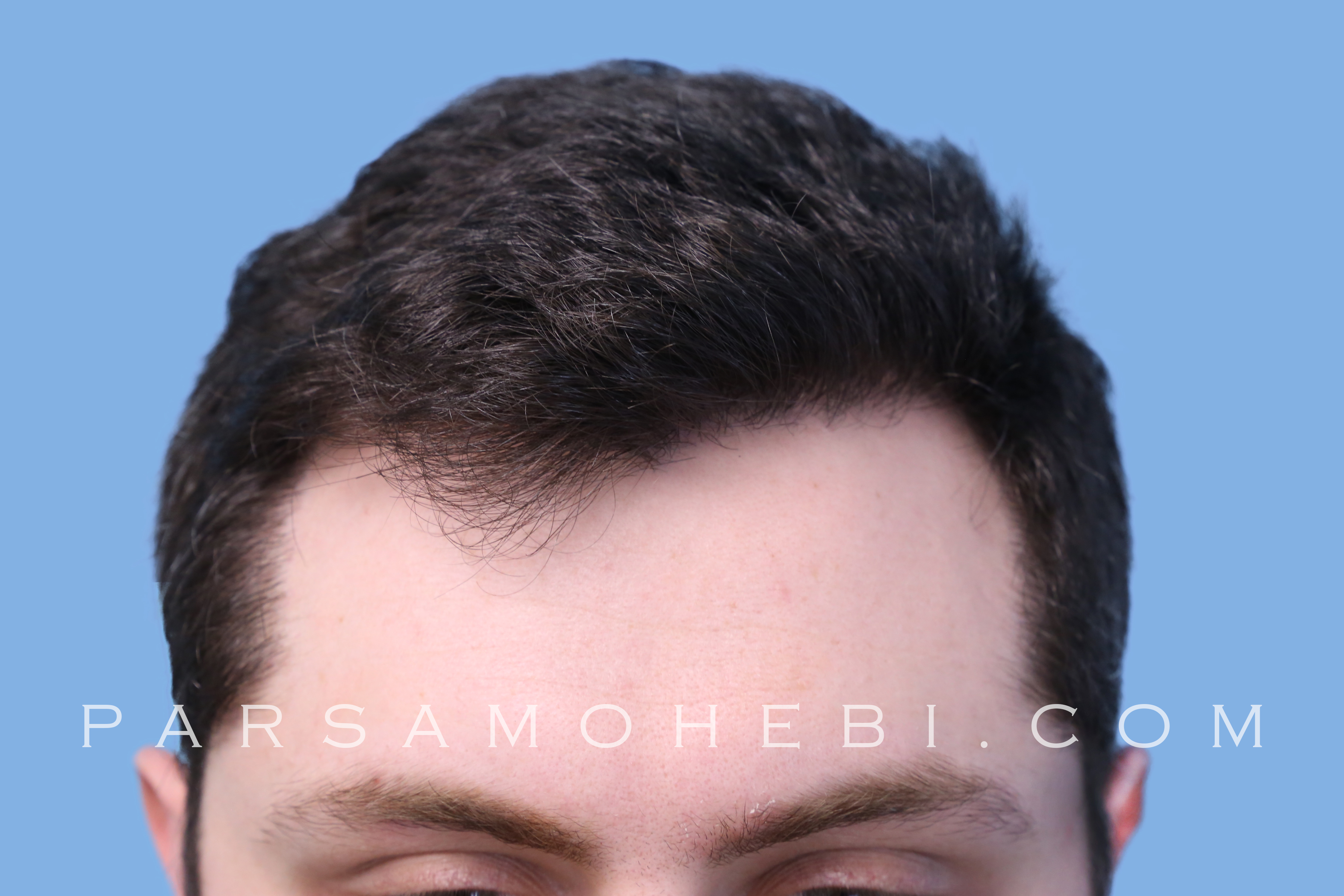 Hair Transplant Recovery Pictures - Hair Transplant Images - Parsa Mohebi  Hair Restoration