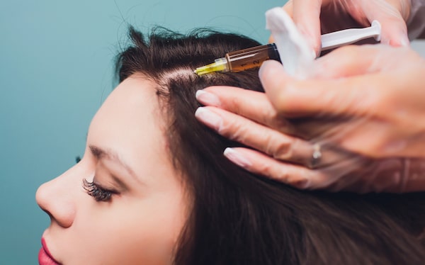 PRP for hair loss - does it work