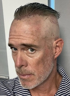 See fans reactions to Joe Buck's Hair Transplant