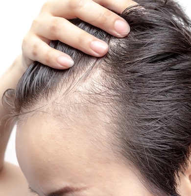 The connection of cortisol and hair loss