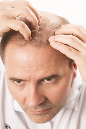 Can SCUBE3 cure hair loss