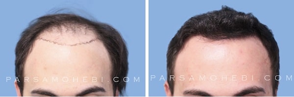 Results after hair restoration