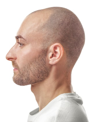 Hair transplant surgery in advance