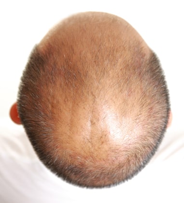 Is baldness related to wisdom