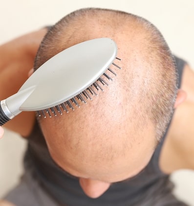 What are some natural hair loss treatments