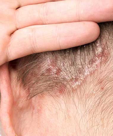 Psoriasis on the scalp treatment