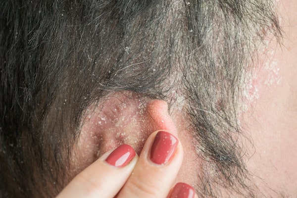 Is hair loss associated to psoriasis