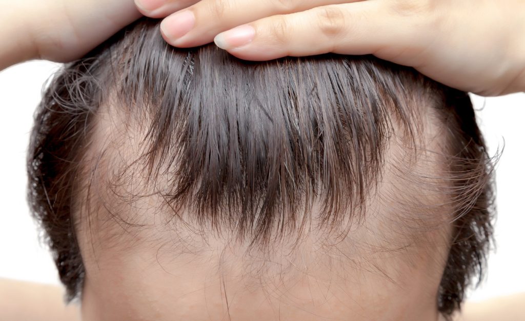 Illustration showing how clascoterone blocks DHT at the hair follicle to help reduce hair loss.